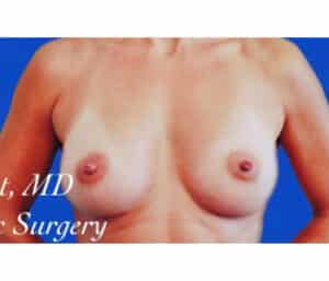 After Image: Breast Augmentation