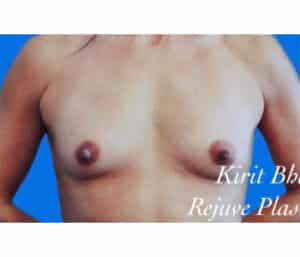 Before Image: Breast Augmentation