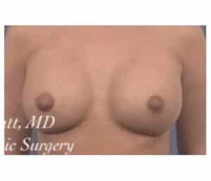 After Image: Breast Augmentation