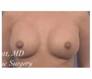 Breast Augmentation