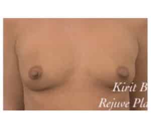 Before Image: Breast Augmentation
