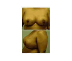 After Image: Breast Reduction