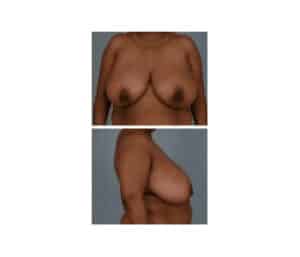 Before Image: Breast Reduction