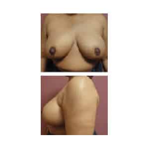 After Image: Breast Reduction