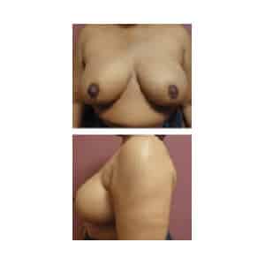 Breast Reduction