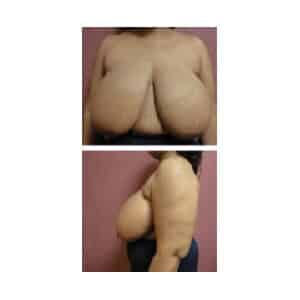 Before Image: Breast Reduction